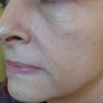 Thermage + Filler Dopo