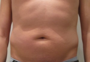 Intralipoterapia Addome 1 Prima
