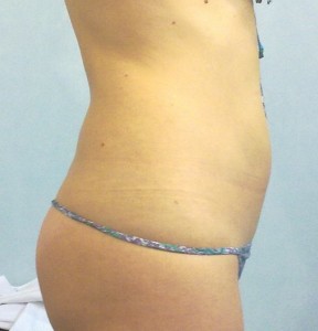Intralipoterapia Addome 5 Dopo