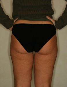 Intralipoterapia Gambe Retro Dopo