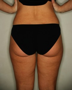 Intralipoterapia Gambe Retro Prima